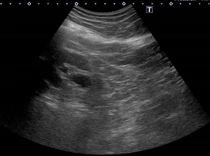 左腎エコー左水腎症